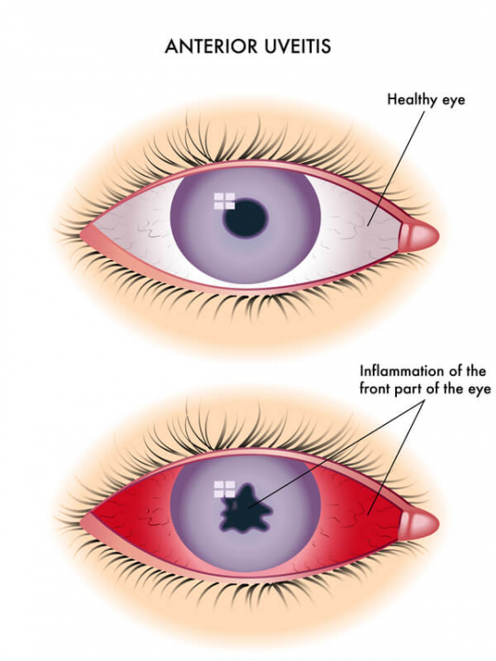 comparision of a normal eye to a eye with Uveitis